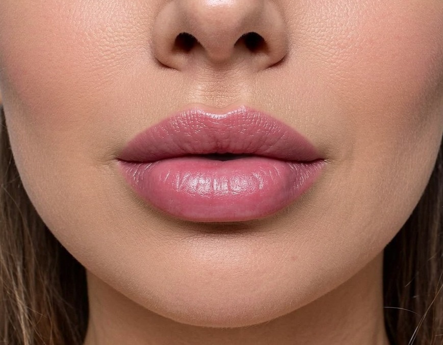 Lip filler treatment at Obsidian Clinics Glasgow